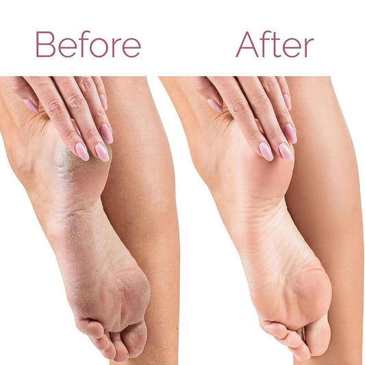 Electric Pedicure Foot File Callus Remover